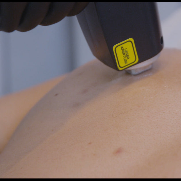 Laser Hair Removal for Men