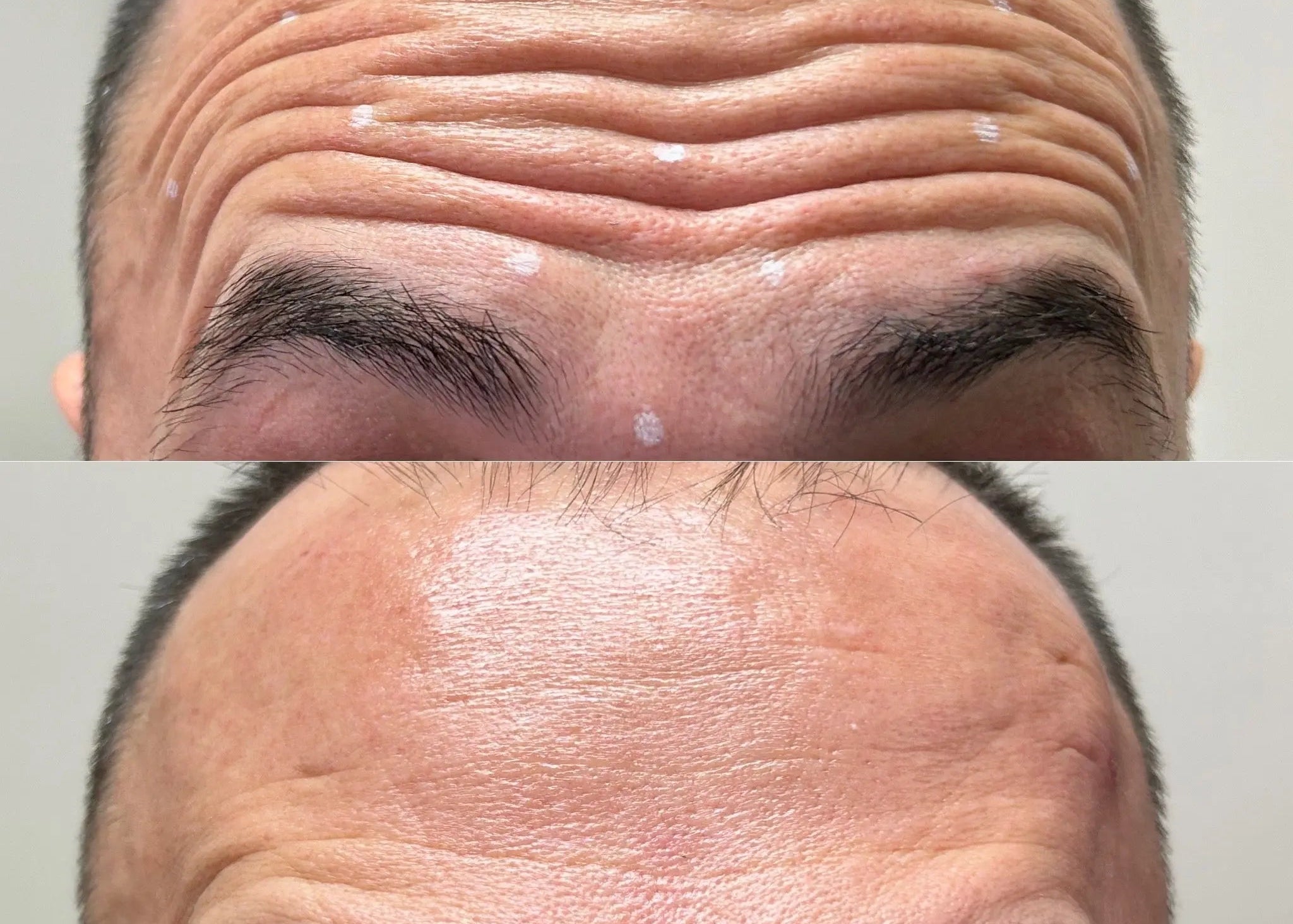 Wrinkle Reducer Treatment for Men 3 Areas SYR Studio