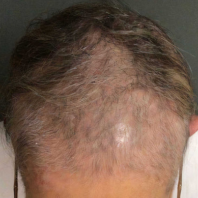 Hair Rejuvenation - Exosomes