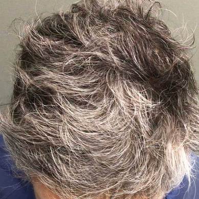 Hair Rejuvenation - Exosomes