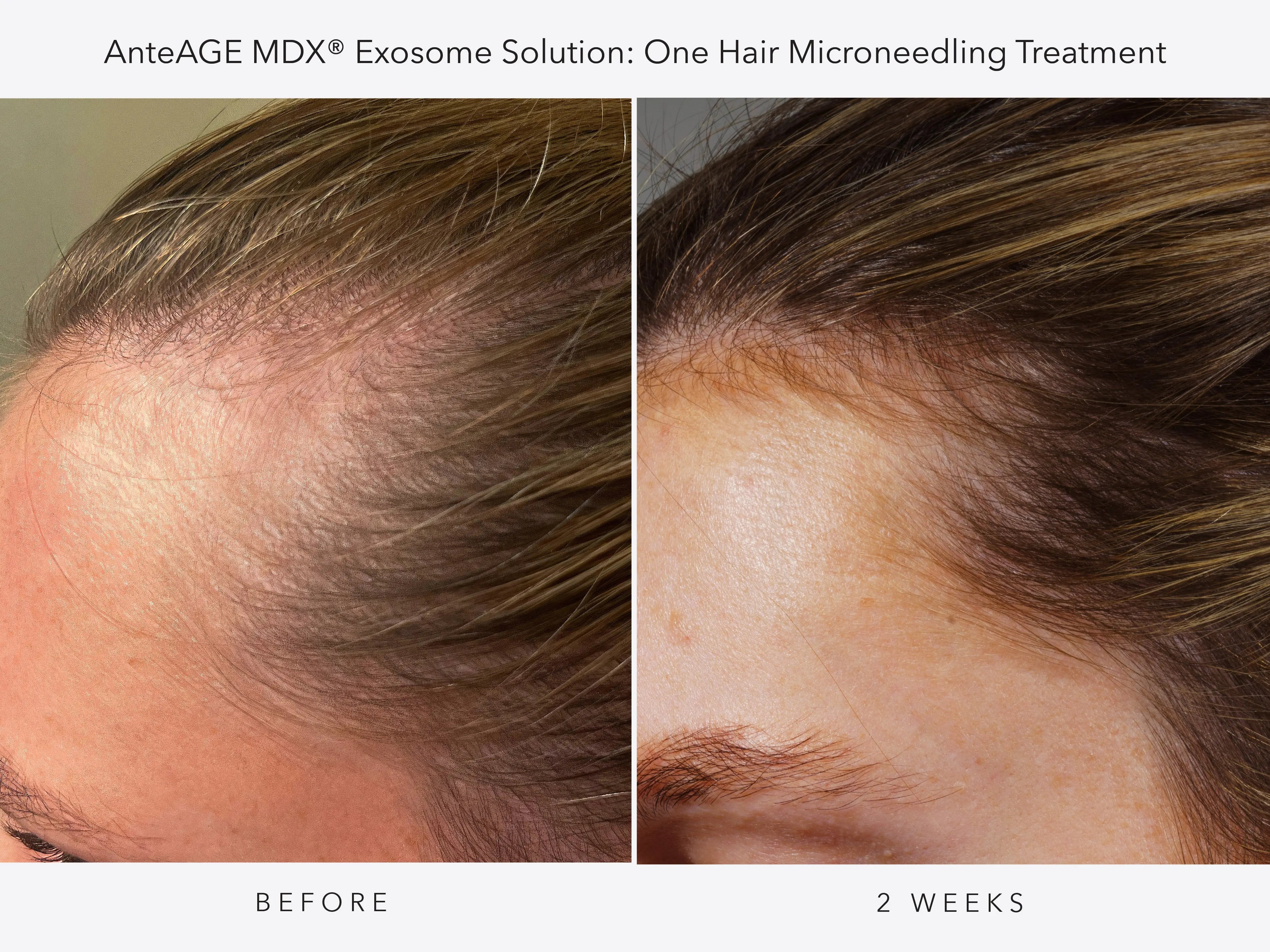 Hair Rejuvenation with AnteAGE® Exosomes (Women’s 3-Session Package) SYR X 4Her
