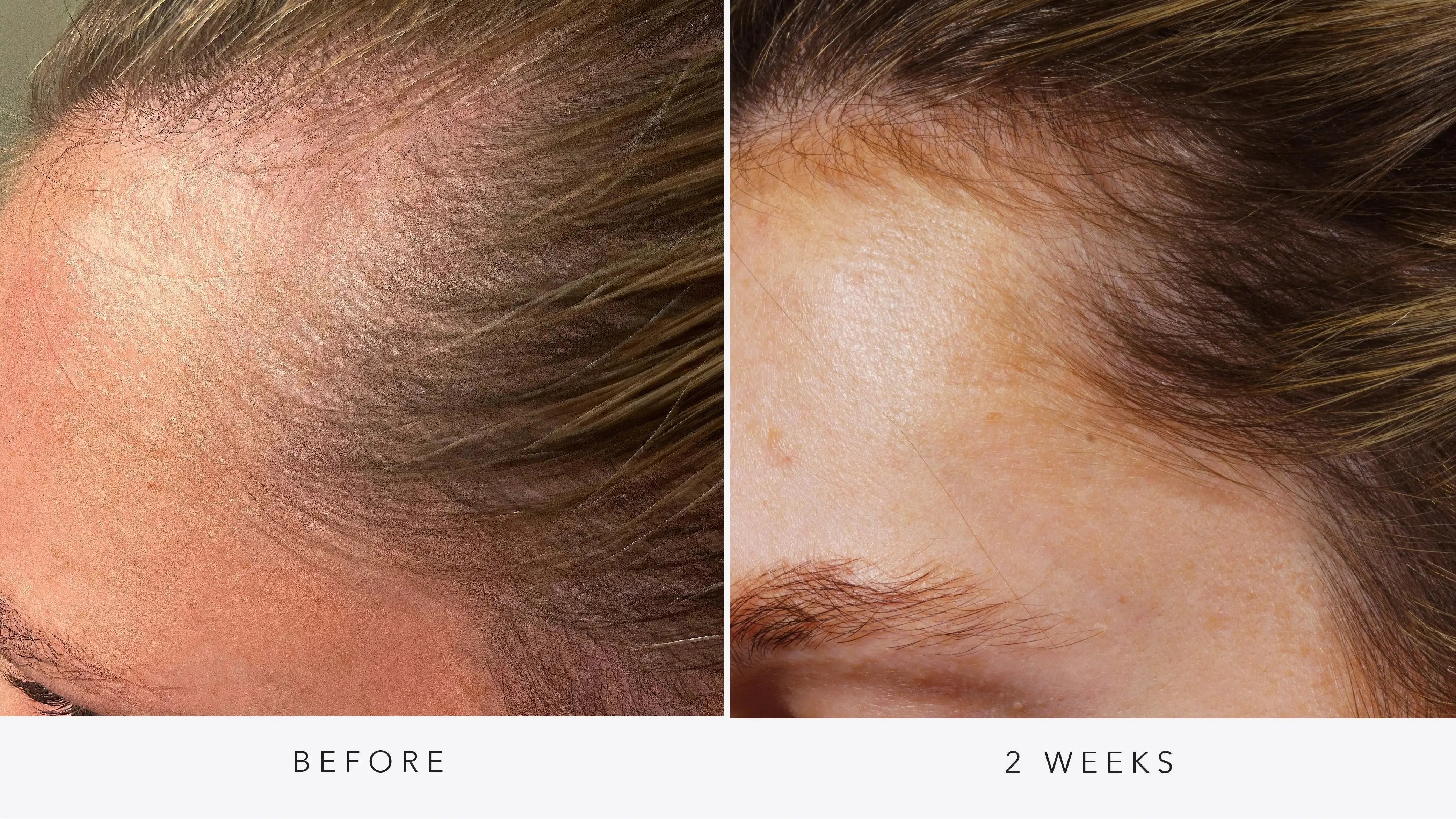 Hair Rejuvenation with AnteAGE® Exosomes (Women’s 3-Session Package) SYR X 4Her