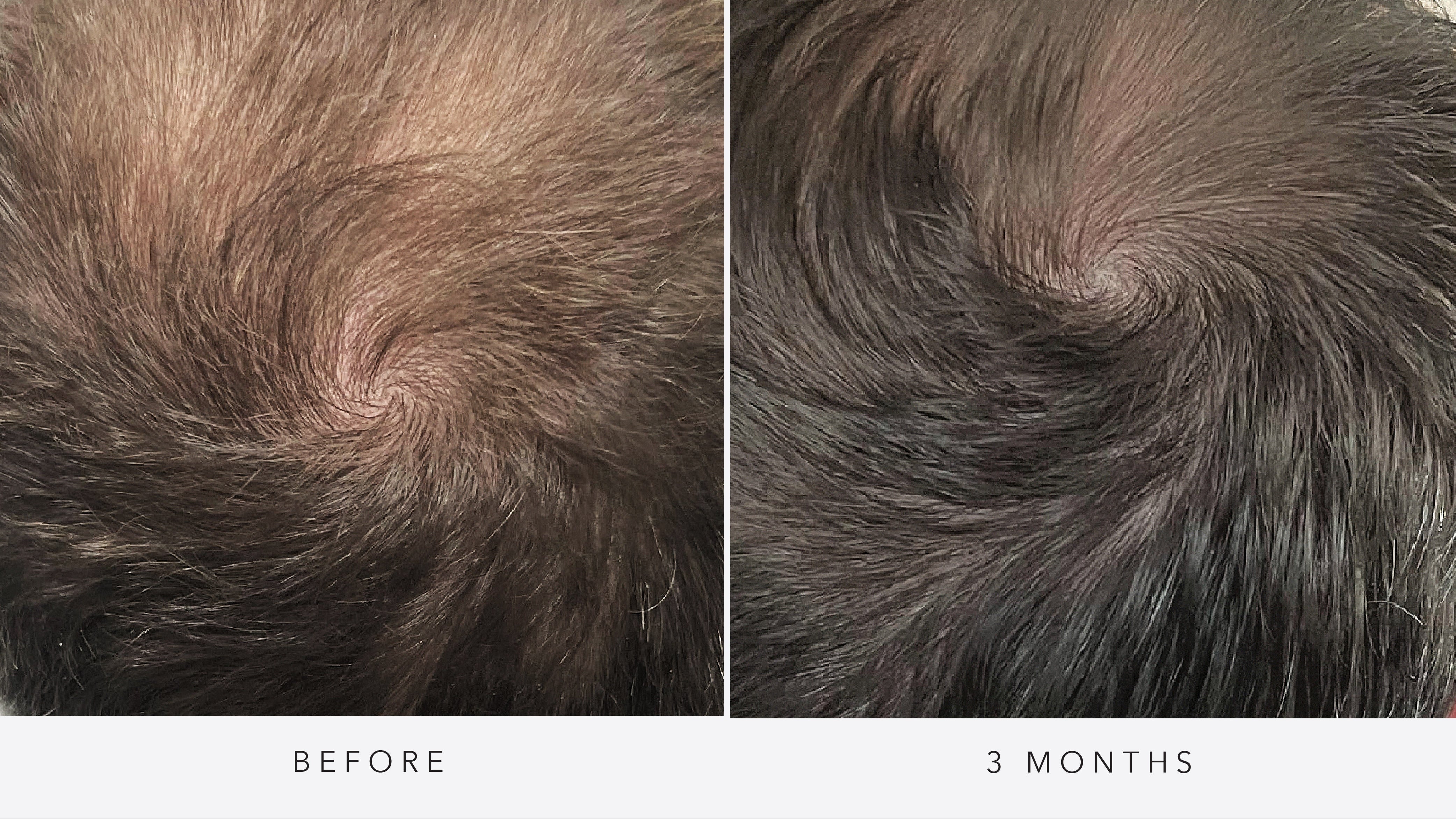 Hair Rejuvenation - Exosomes