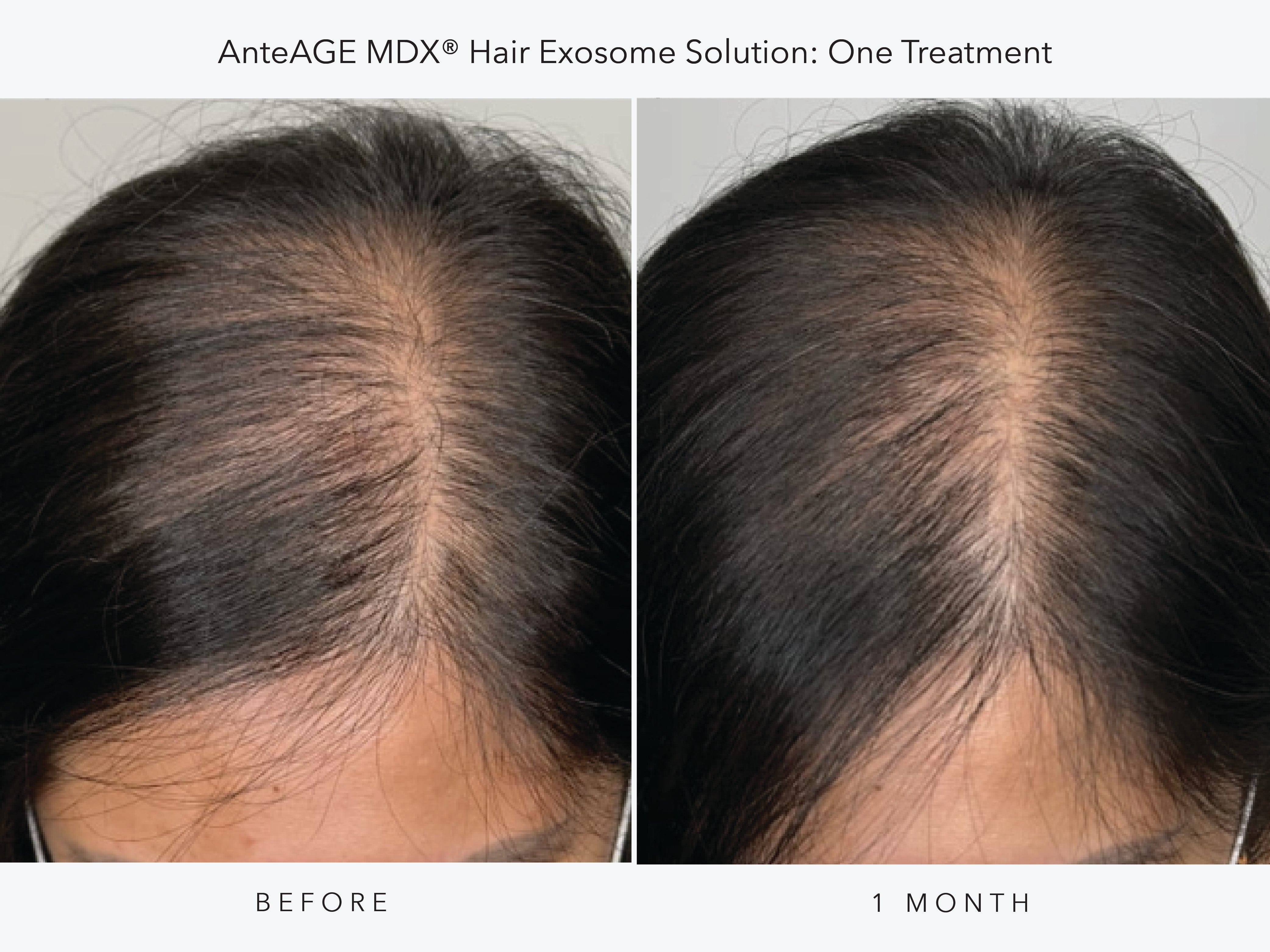 Hair Rejuvenation with AnteAGE® Exosomes (Women’s 3-Session Package)