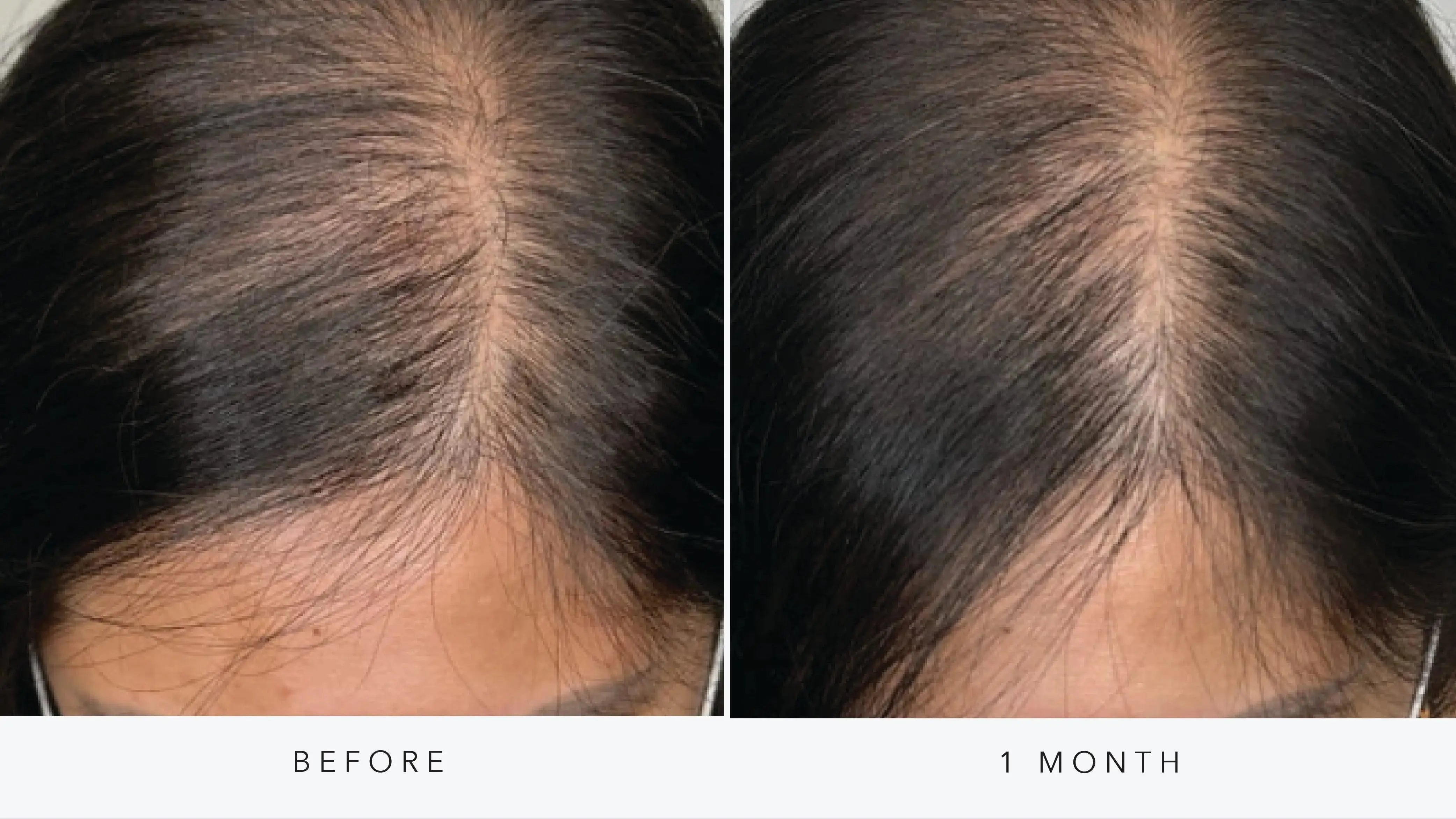 Hair Rejuvenation with AnteAGE® Exosomes (Women’s 3-Session Package) SYR X 4Her