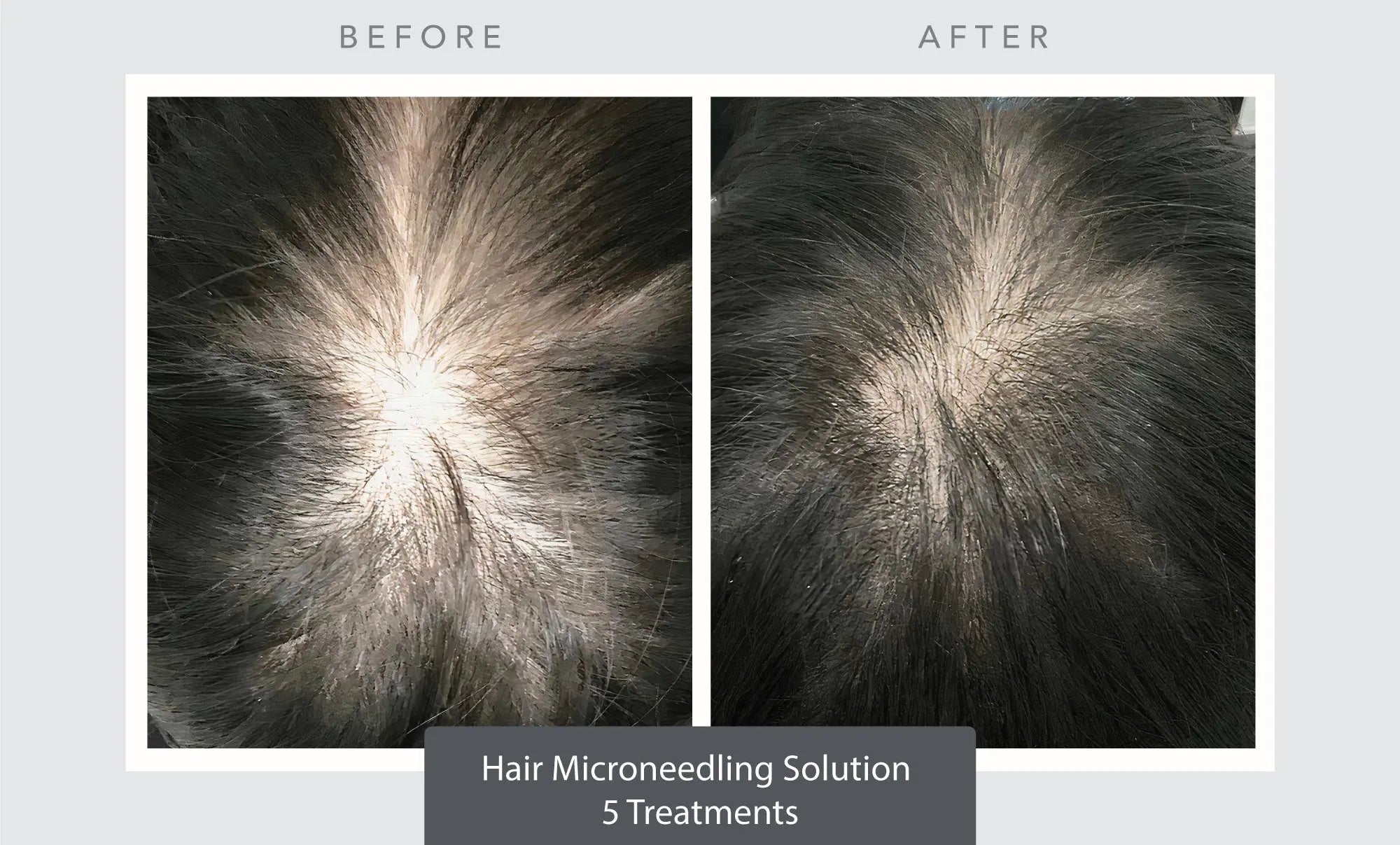 Hair Rejuvenation - Exosomes SYR Studio