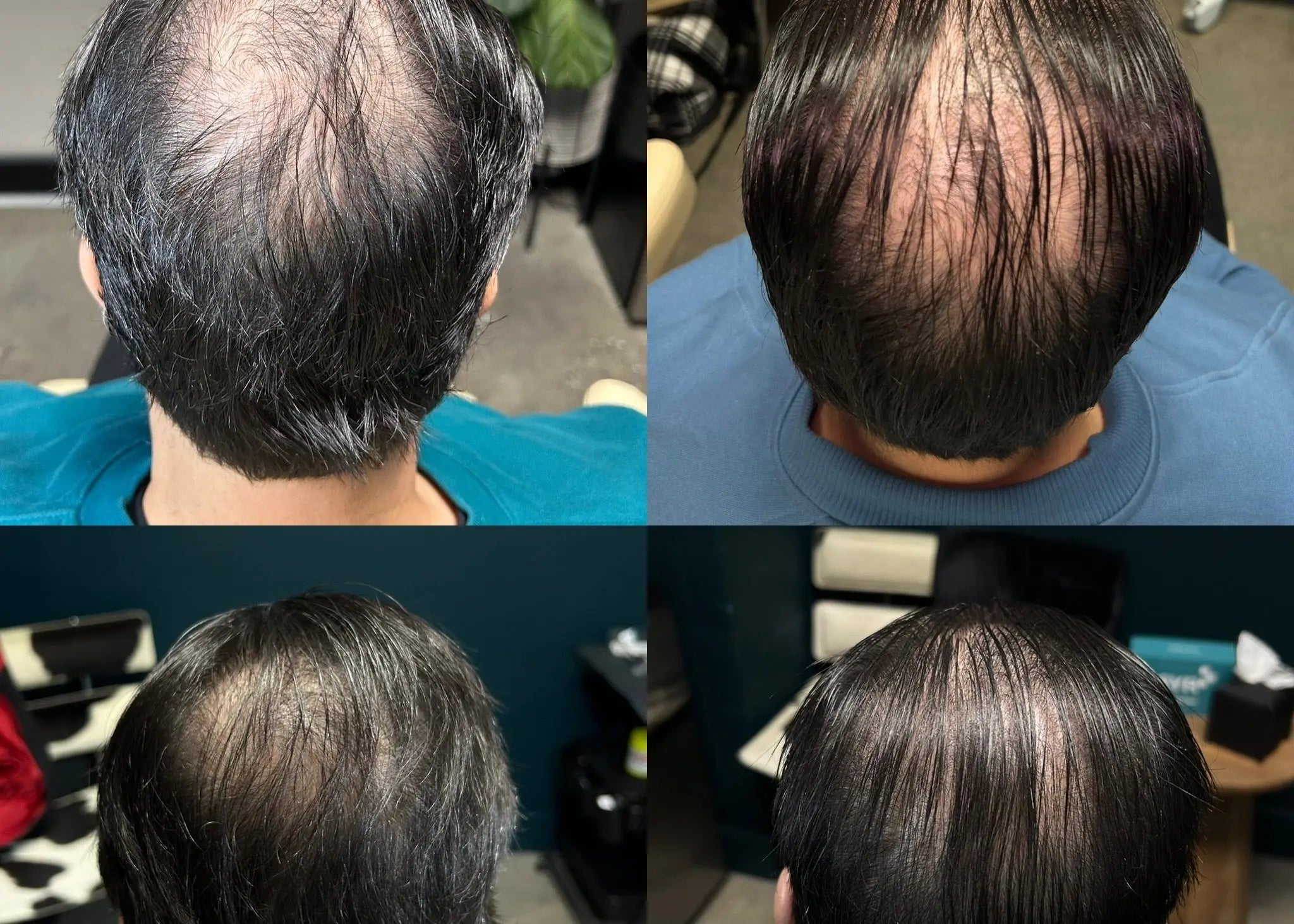 Hair Density Portfolio - SYR X 4Her