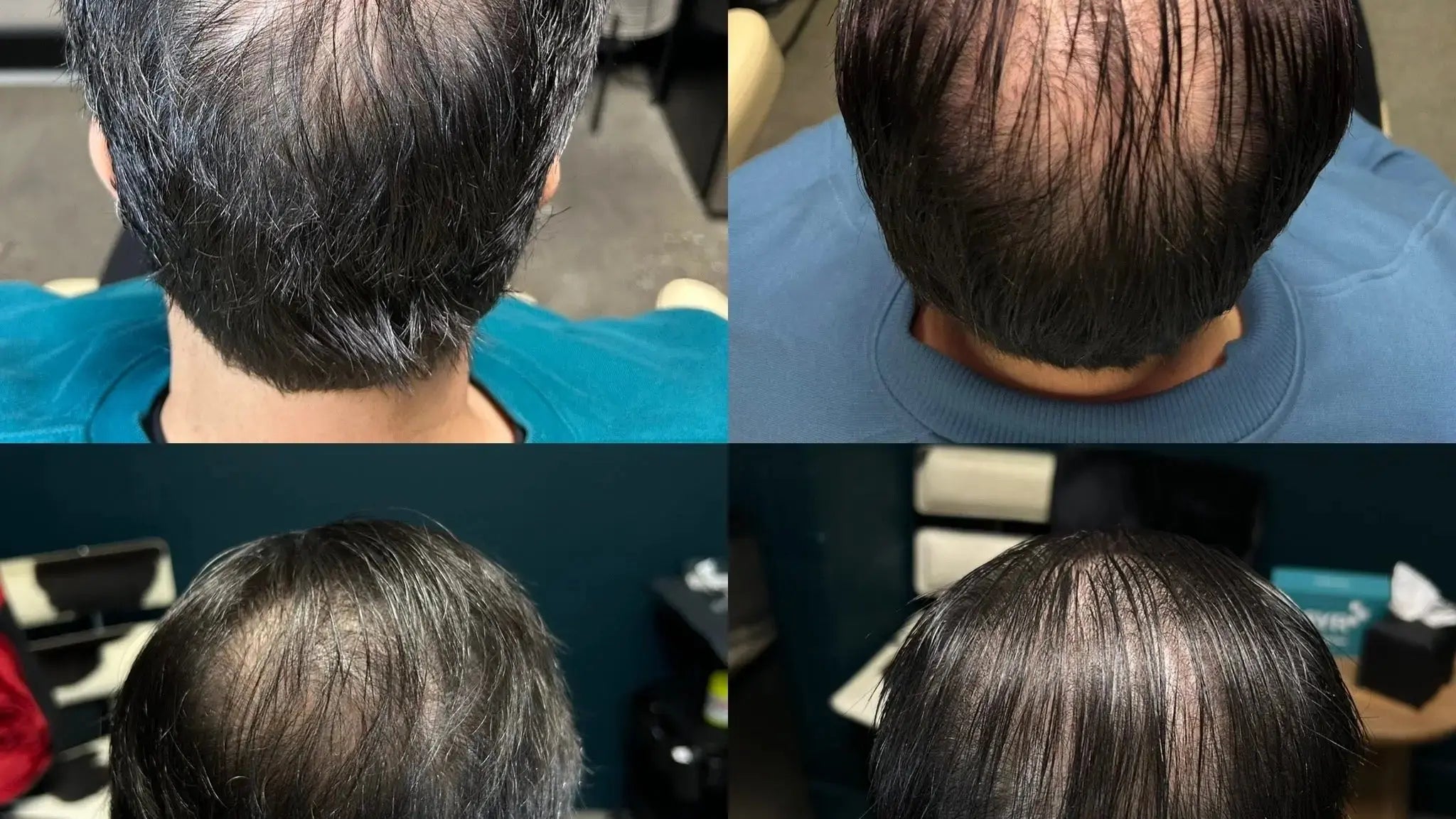 Hair Density Portfolio - SYR X 4Her