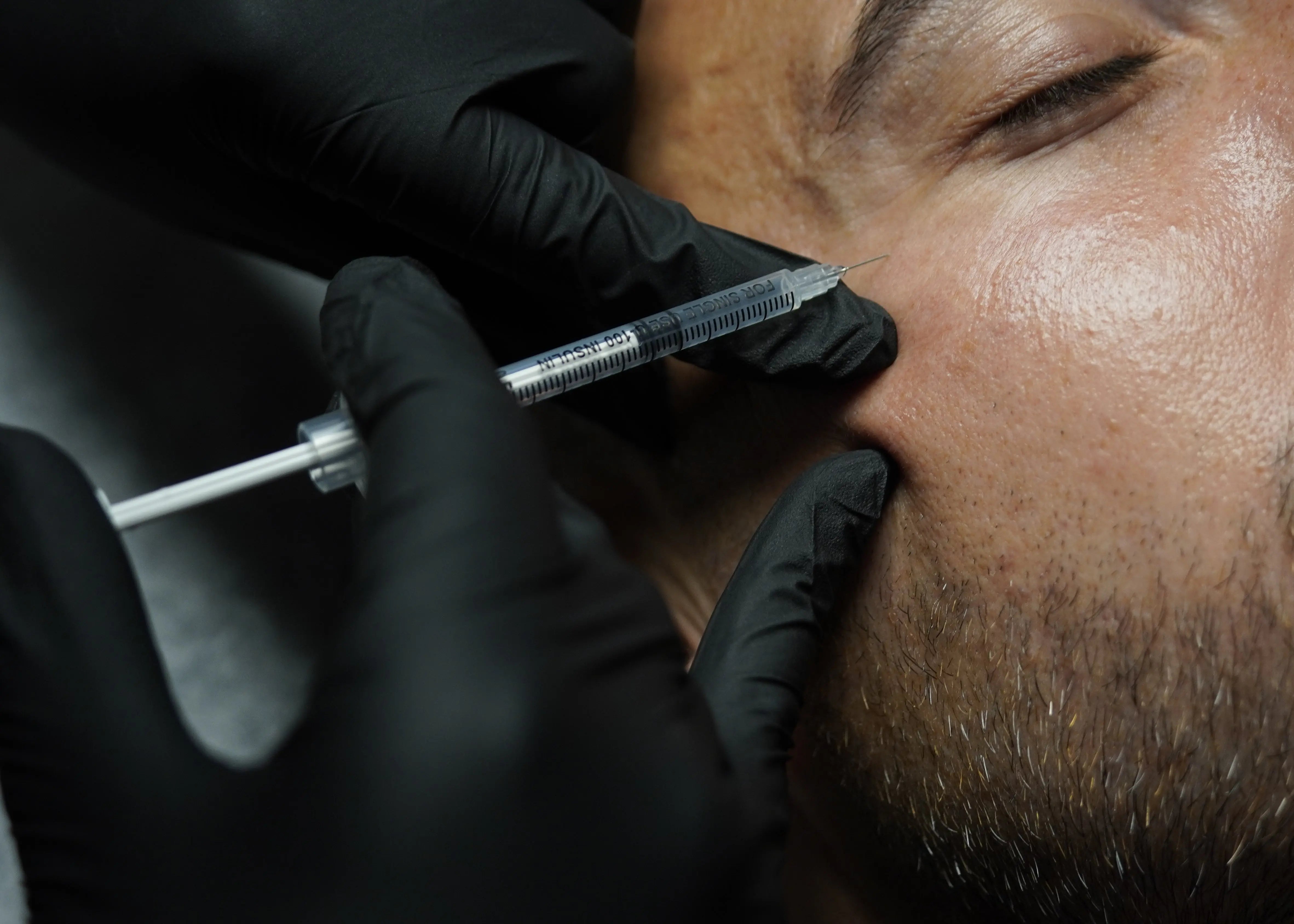 man receiving botox injections in the crows feet