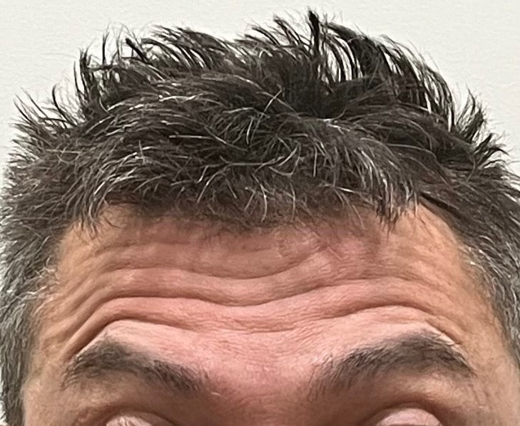 Wrinkle Reducer Treatment for Men 3 Areas