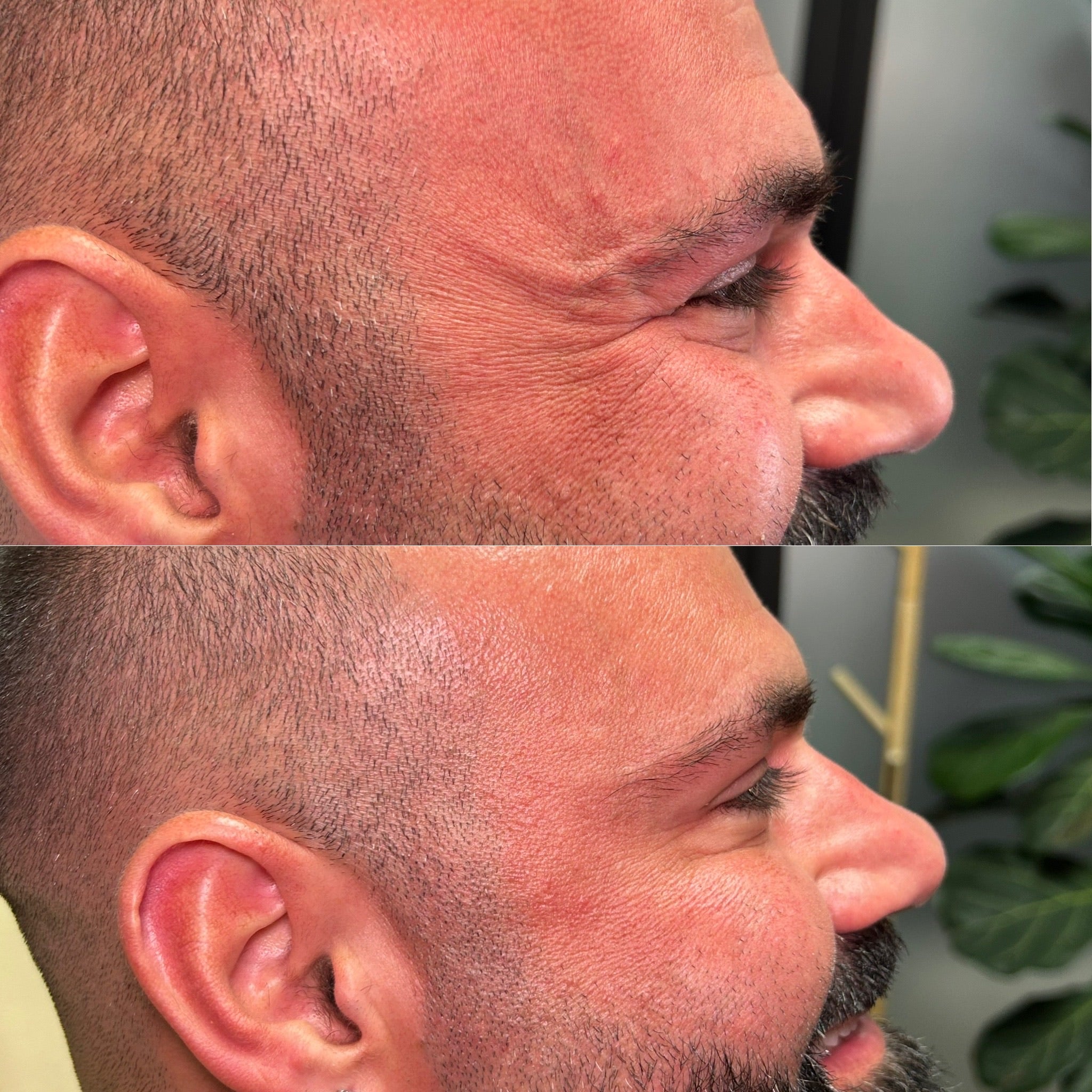 Wrinkle Reducer Treatment for Men 3 Areas