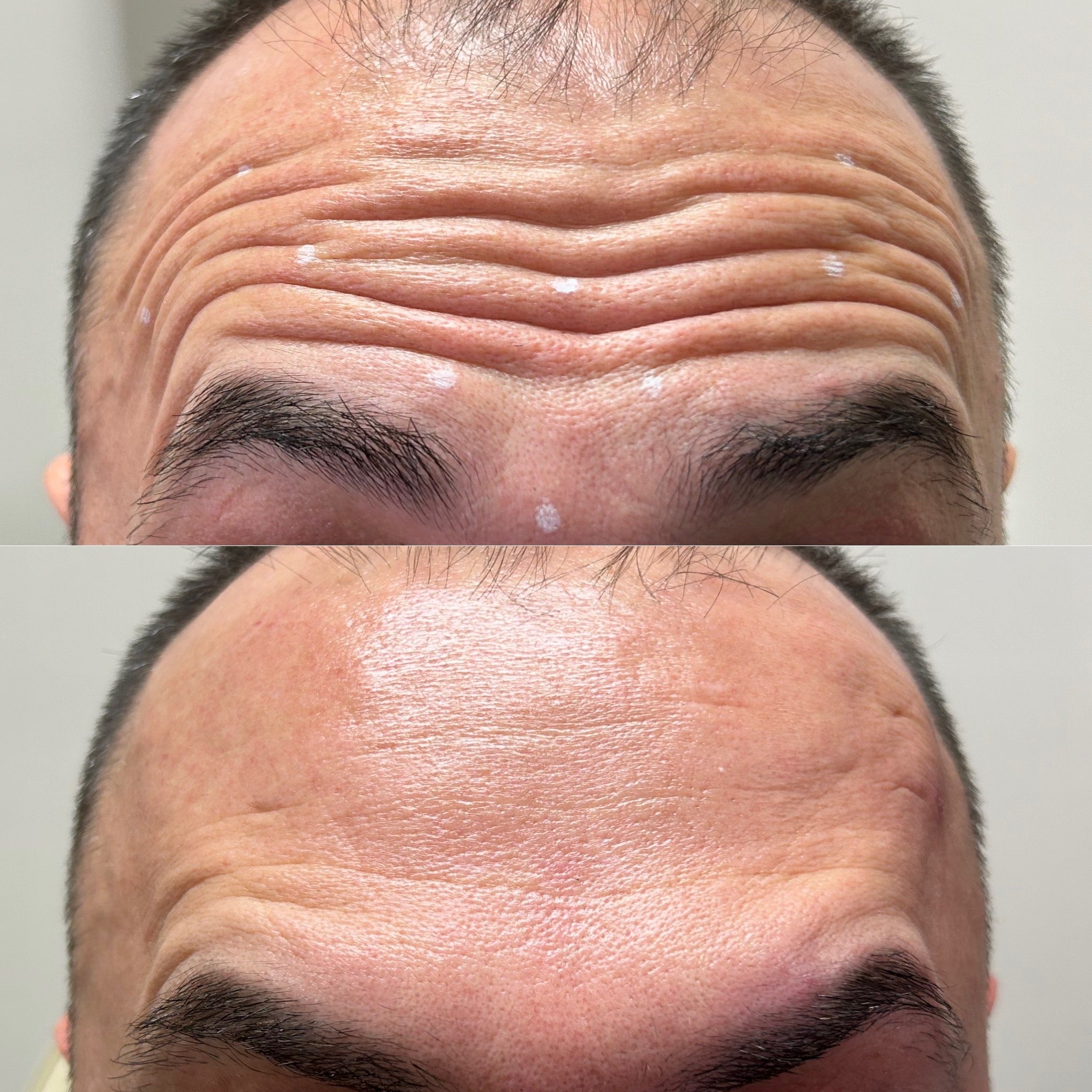 Wrinkle Reducer Treatment for Men 3 Areas
