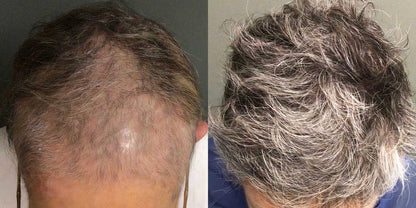 Exosomes for Hair Rejuvenation