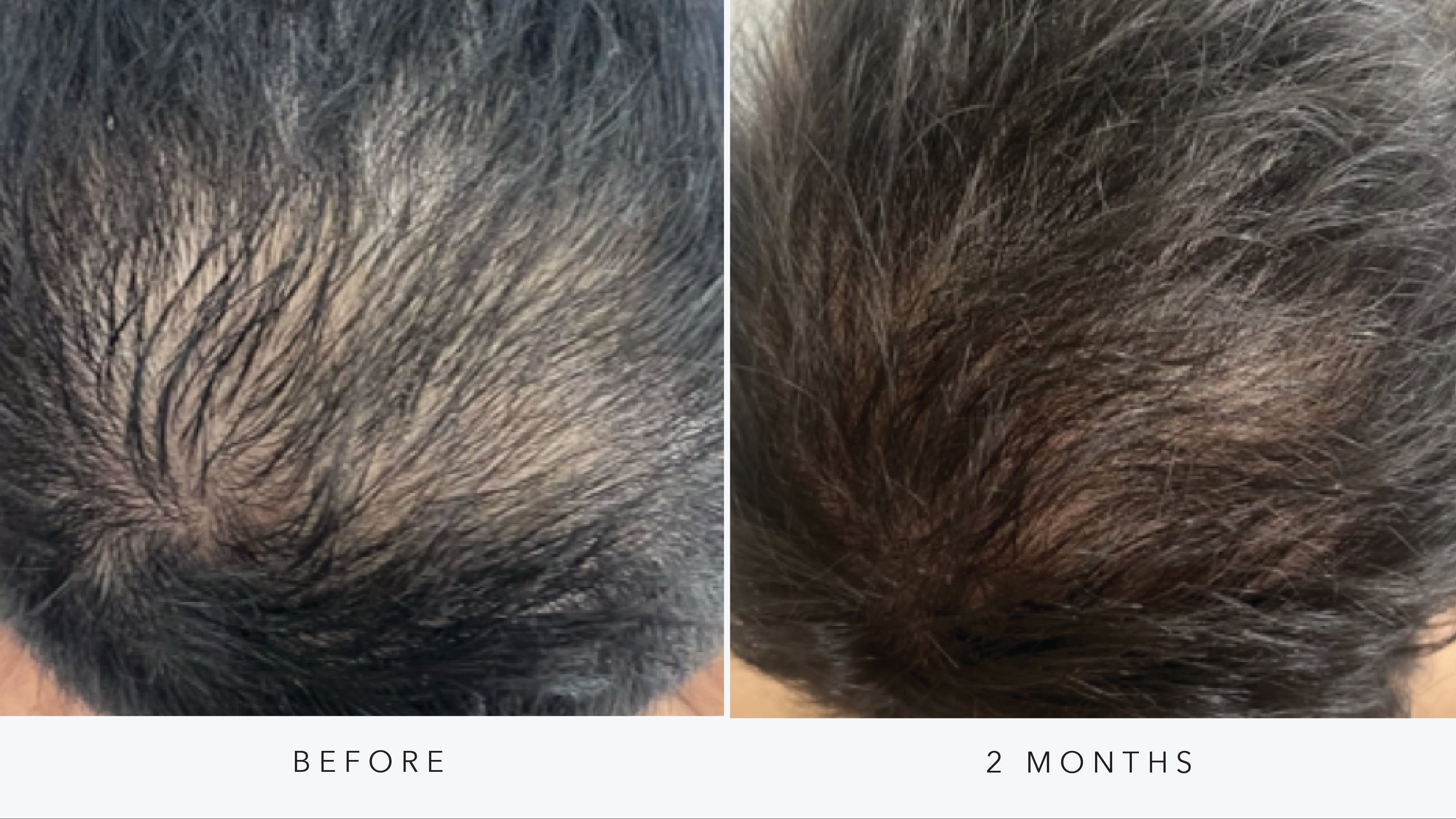 Hair Rejuvenation - Exosomes