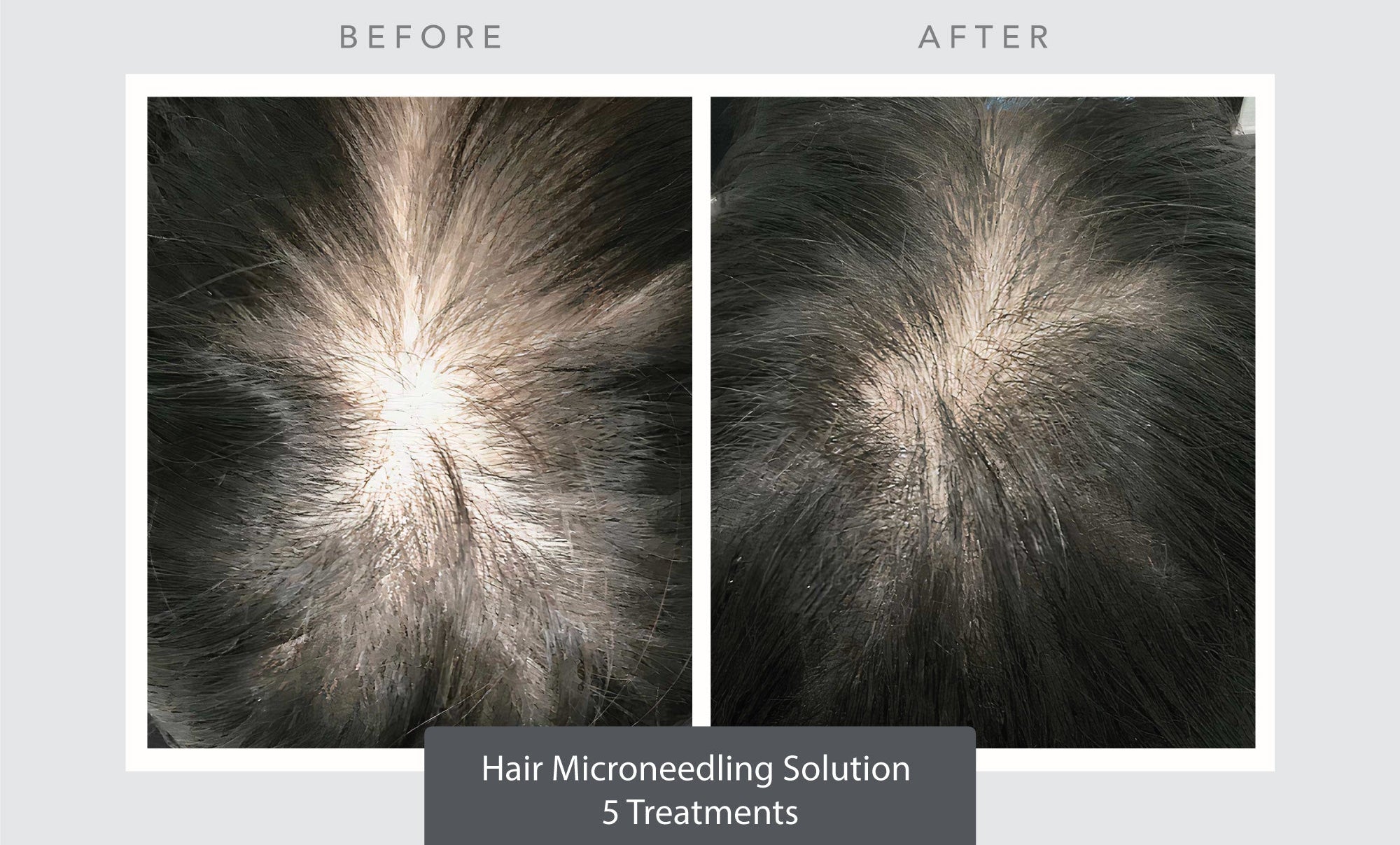 Hair Rejuvenation - Exosomes