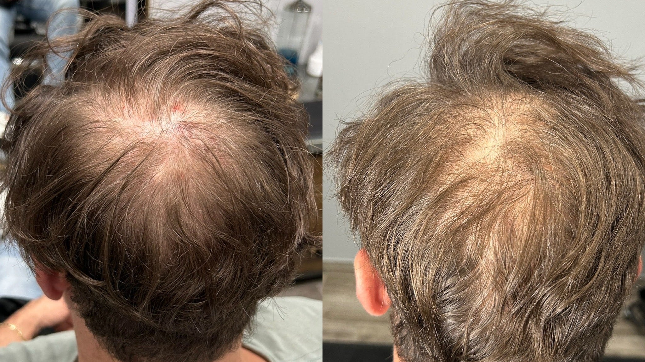 Hair Rejuvenation - Exosomes