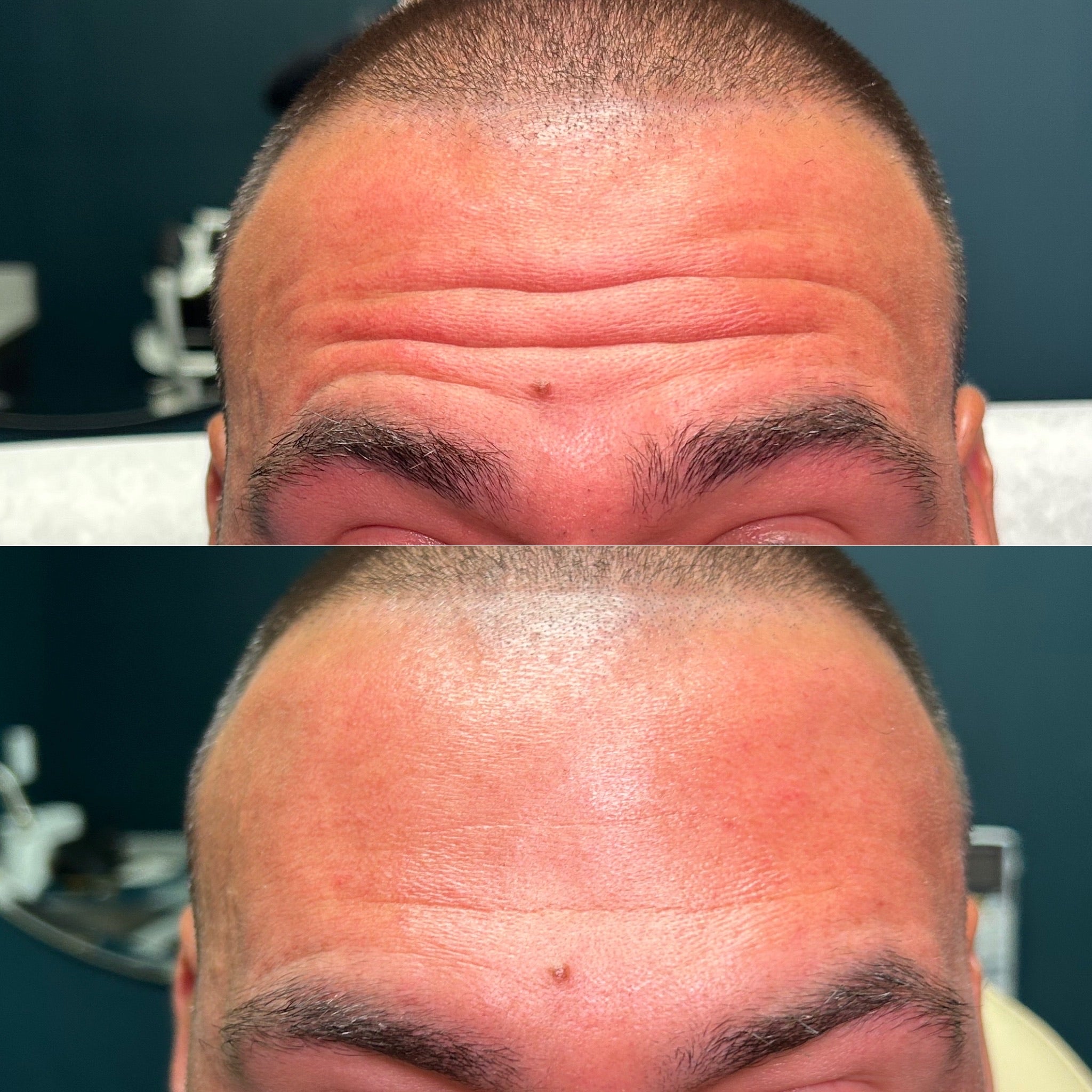 Wrinkle Reducer Treatment for Men 3 Areas