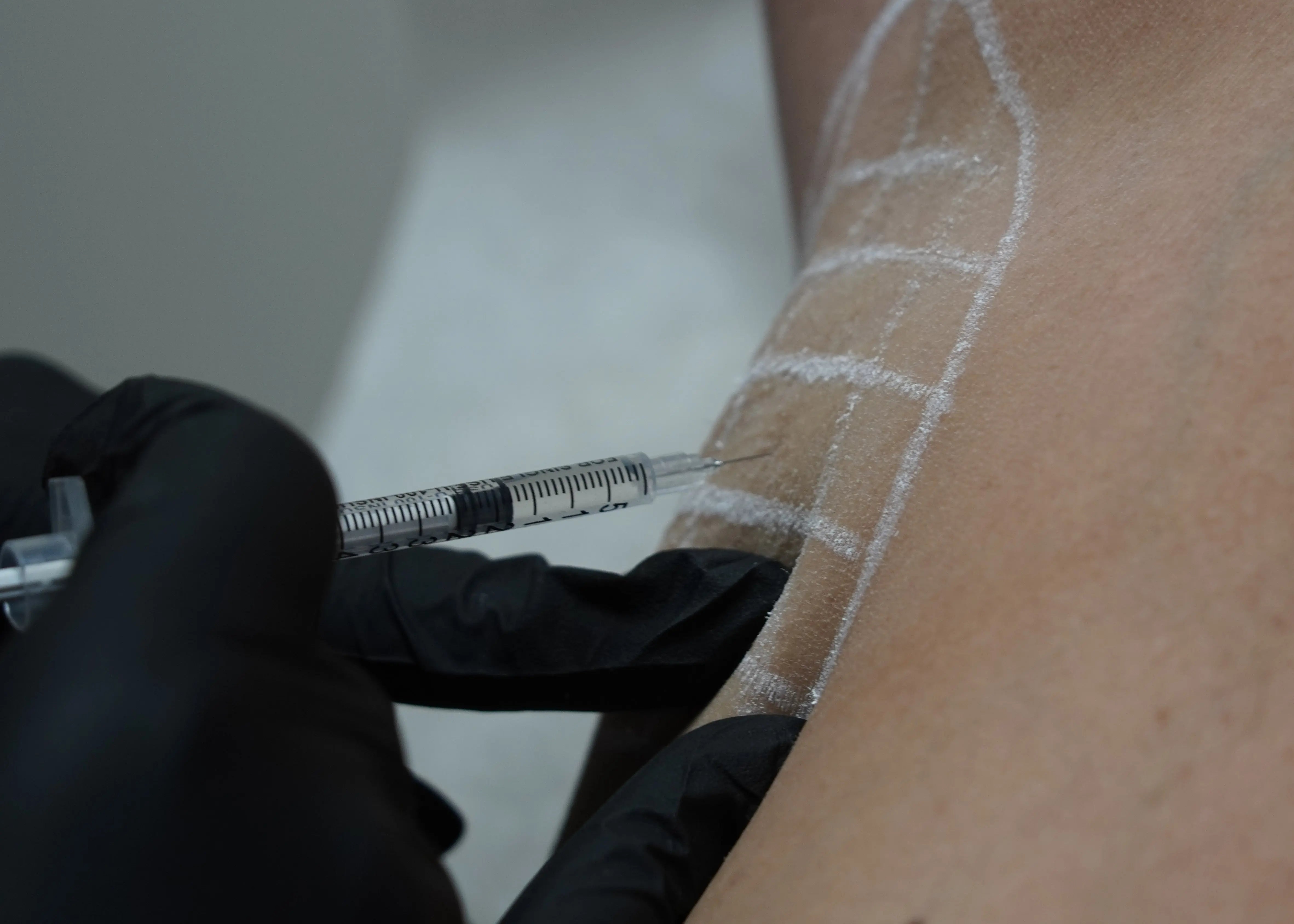 Person receiving a botox injection for underarms