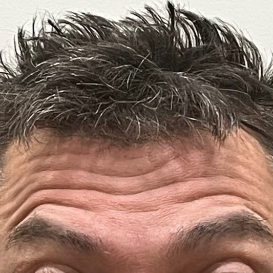 Wrinkle Reducer Treatment for Men 3 Areas