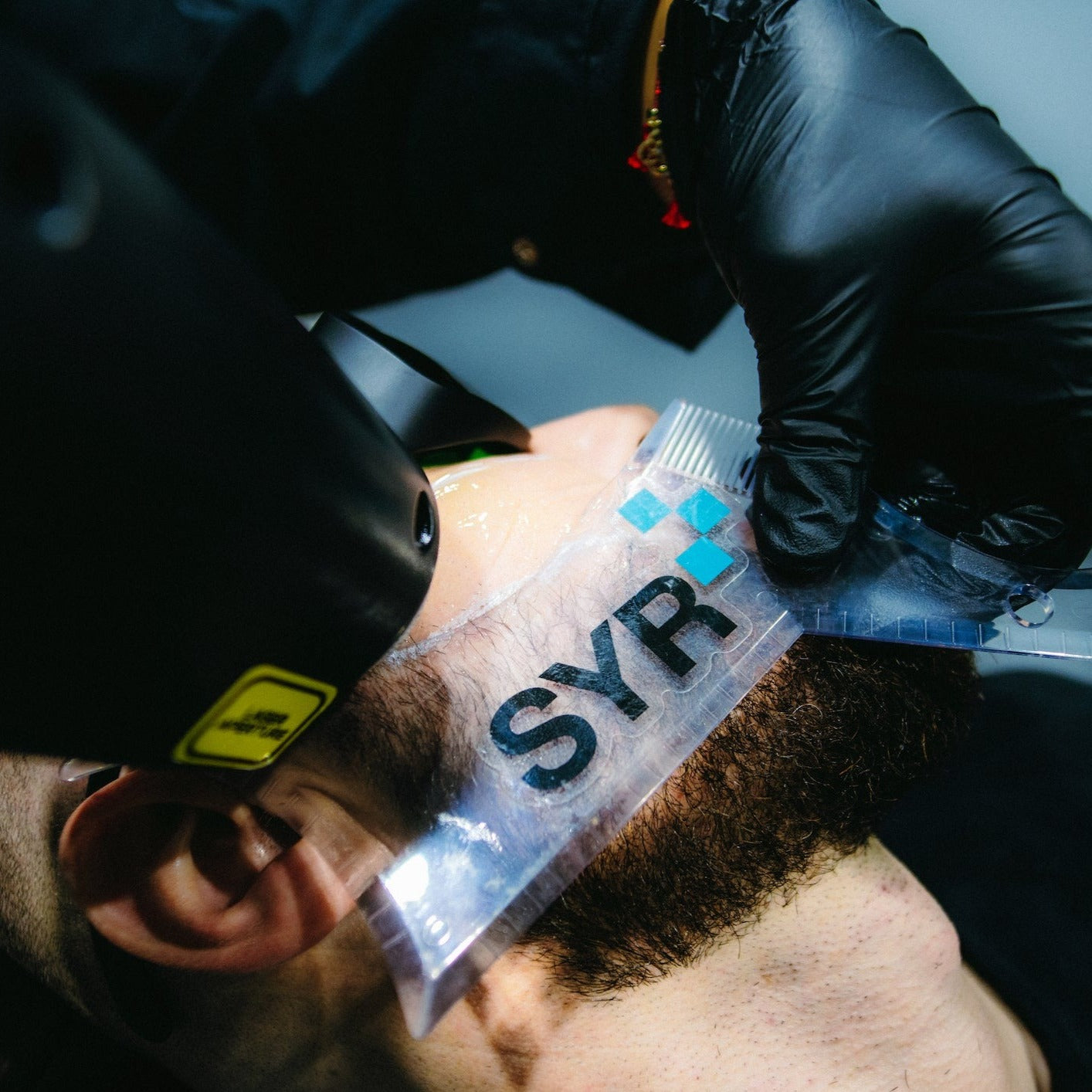 Laser Barbering- Beard 6 Sessions